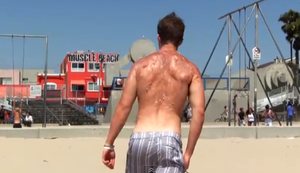 Sonnenbrand der übelsten Sorte